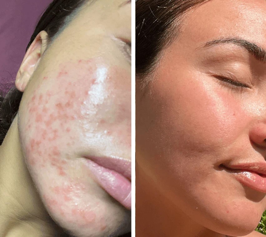 Meliora LumiSkin Pro - Rotlichttherapie Gesichtsmaske