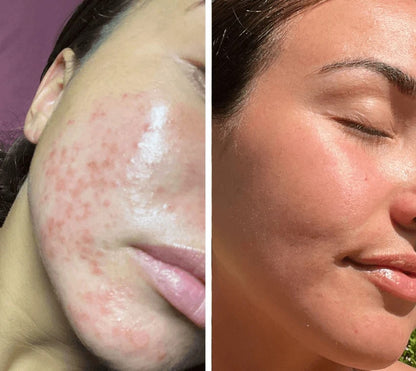 Meliora LumiSkin Pro - Rotlichttherapie Gesichtsmaske